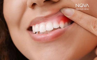 Parodontalni džep – tihi neprijatelj naših zuba