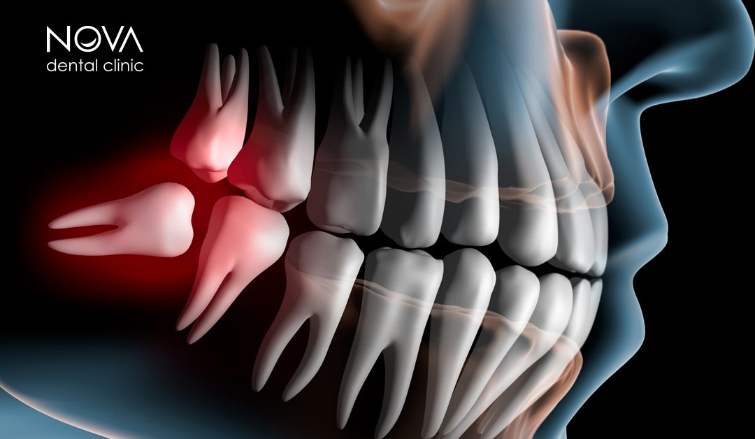 Umnjaci – „tvrdoglavi“ zubi koji nam stvaraju probleme