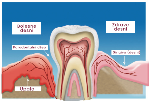 Parodontalni,Parodontalni dzep,Sarajevo klinika,Dental klinika Sarajevo,Nova Dental Clinic,Nova Dental Sarajevo,Blog