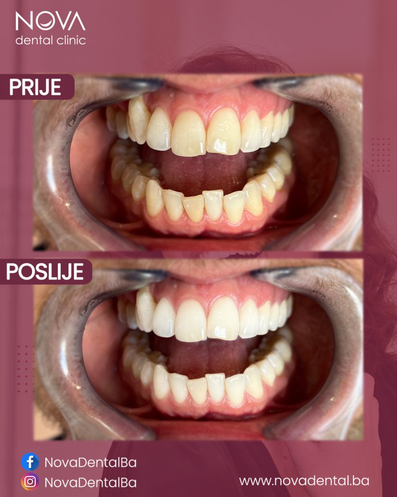 Prije i poslije tretmana izbjeljivanja zubi