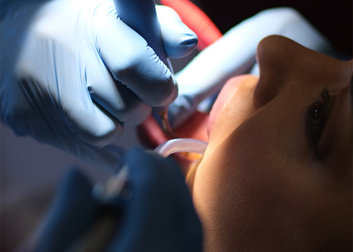 izbjeljivanje zuba nova dental clinic sarajevo 002