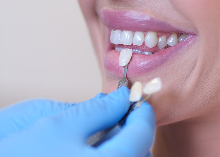 izbjeljivanje zuba nova dental clinic sarajevo 003
