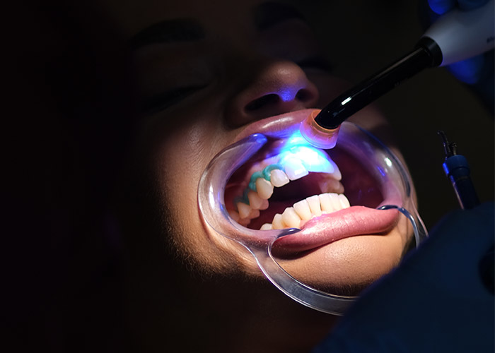 izbjeljivanje zuba nova dental clinic sarajevo 004