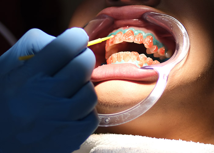 izbjeljivanje zuba nova dental clinic sarajevo 005