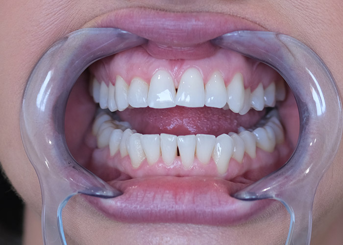 izbjeljivanje zuba nova dental clinic sarajevo 006