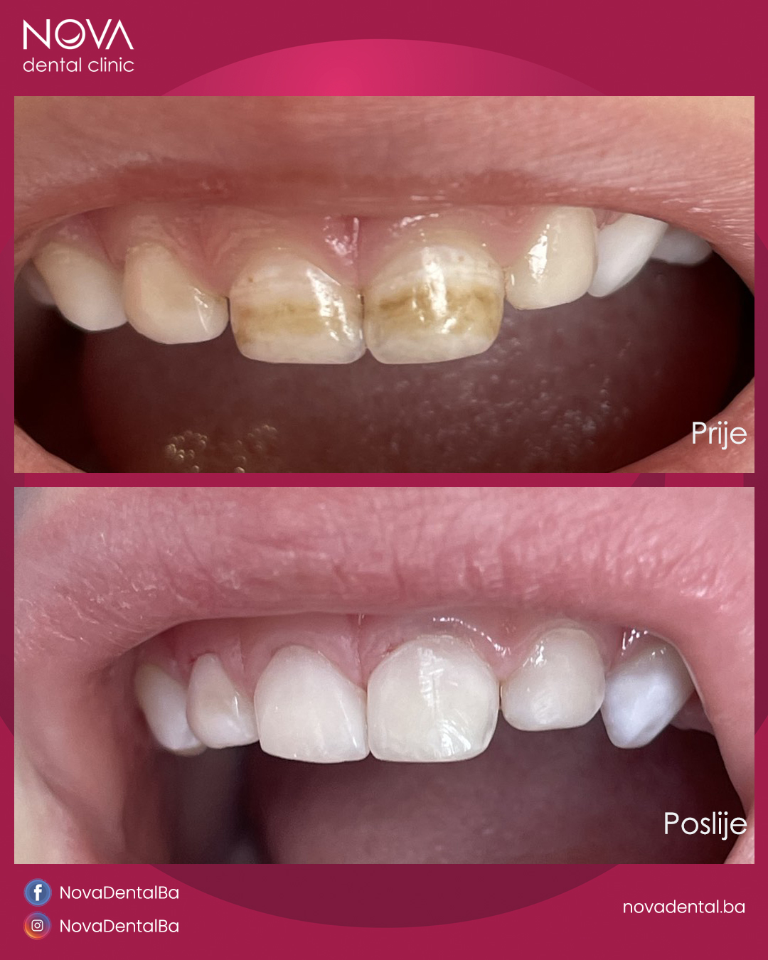 mlijecni zubi prije i poslije