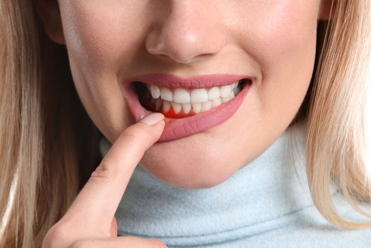 Subgingivalna kiretaža: vaš saveznik u borbi protiv gubitka zuba